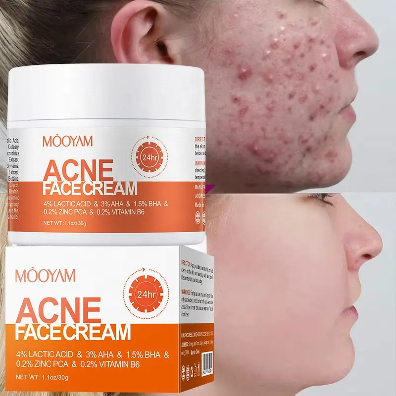 Private Label Fast Effective Clears Blemish Pimple Remover Spot Whitening Skin Anti Acne Cream